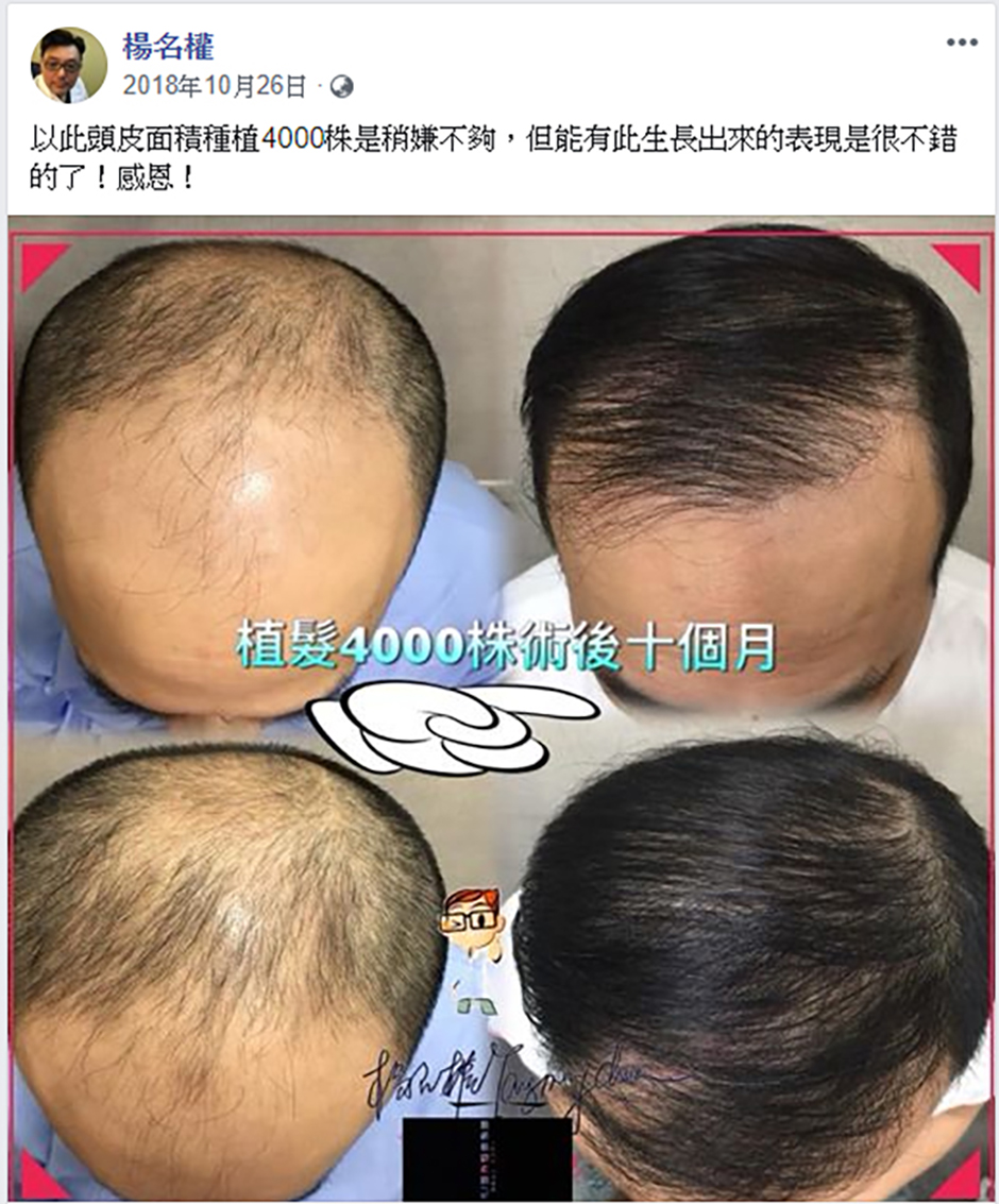 植髮,禿髮,楊氏羅丹,六合一三階段雄性禿治療 案例分享